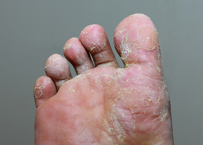 Tinea Pedis - fugal infections of the foot | Durban Skin Doctor